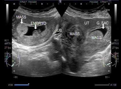 Uterus Fibroids Ultrasound